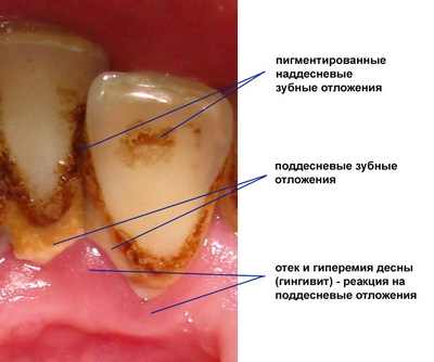 прорезывание коренных зубов у детей симптомы фото