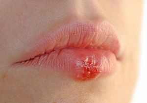 Простуда на губе у ребенка чем лечить