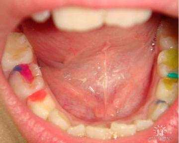пульпит молочных зубов у детей отзывы