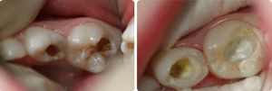 Пульпит молочных зубов у детей отзывы
