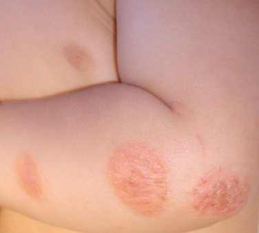 рефлюкс эзофагит у грудных детей