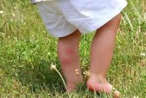 Симптомы клещевого энцефалита у ребенка