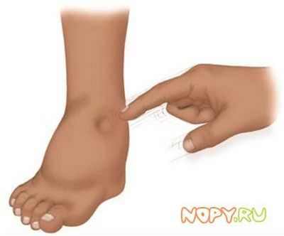 синяки на ногах у ребенка лечение