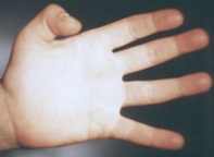 Стенозирующий лигаментит пальцев кисти у детей лечение