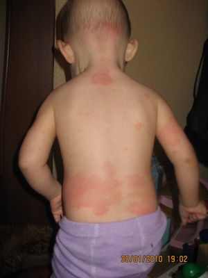 температура и красные пятна на теле у ребенка