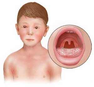 увеличение миндалин у детей симптомы