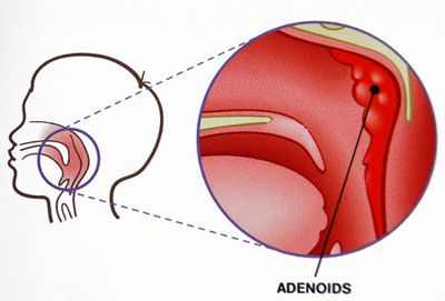 воспаление аденоидов у ребенка 3 лет