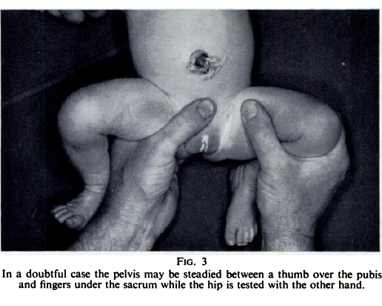 задержка развития тазобедренных суставов детей 2 месяца